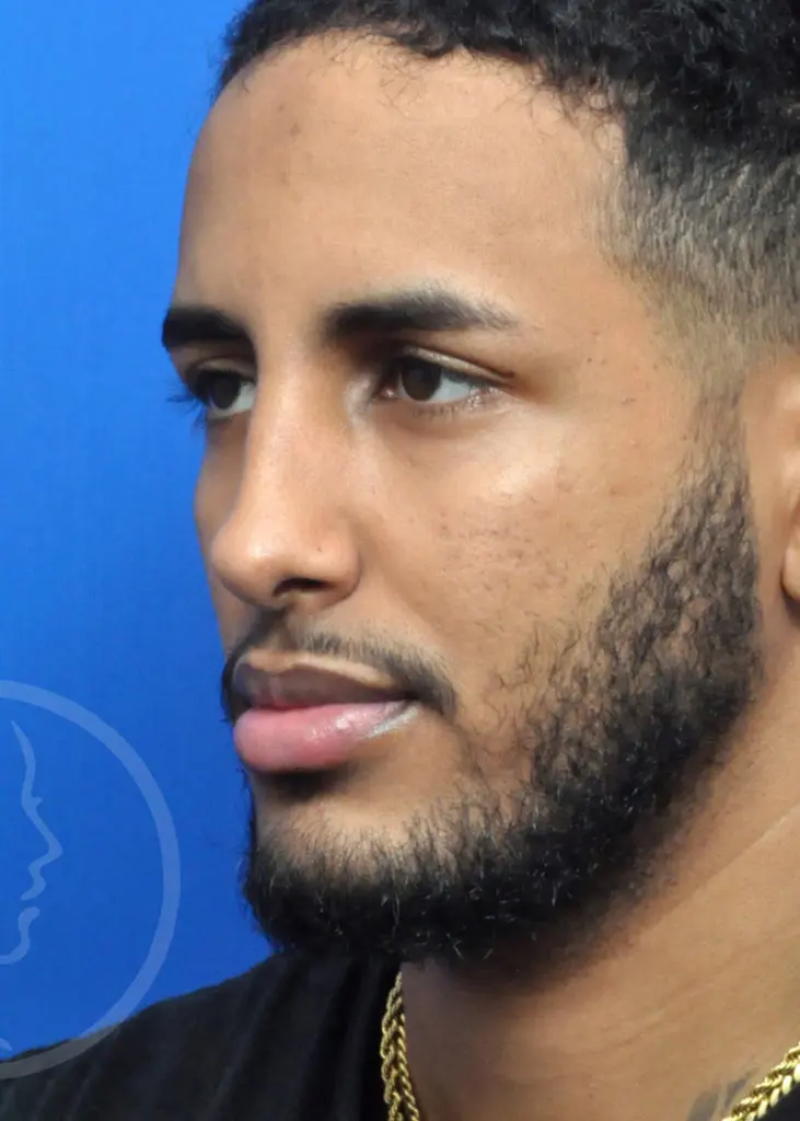 Plastic Surgery Before and After Pictures in Jacksonville, FL - Garcia Facial Plastic Surgery