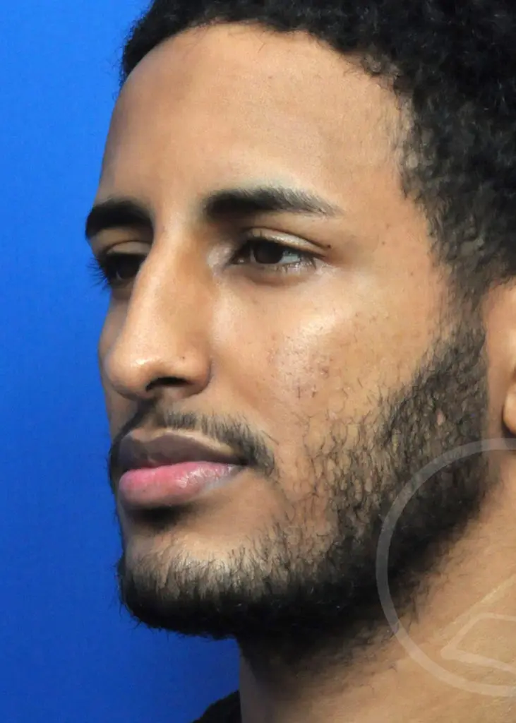 Plastic Surgery Before and After Pictures in Jacksonville, FL - Garcia Facial Plastic Surgery