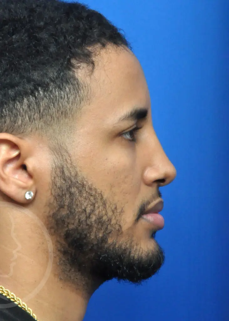 Plastic Surgery Before and After Pictures in Jacksonville, FL - Garcia Facial Plastic Surgery