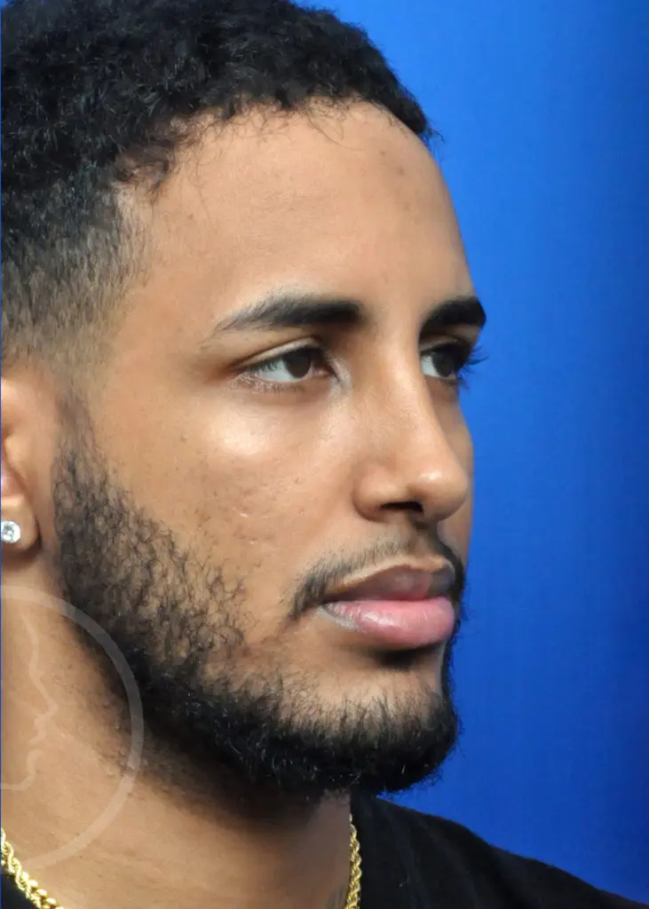 Plastic Surgery Before and After Pictures in Jacksonville, FL - Garcia Facial Plastic Surgery