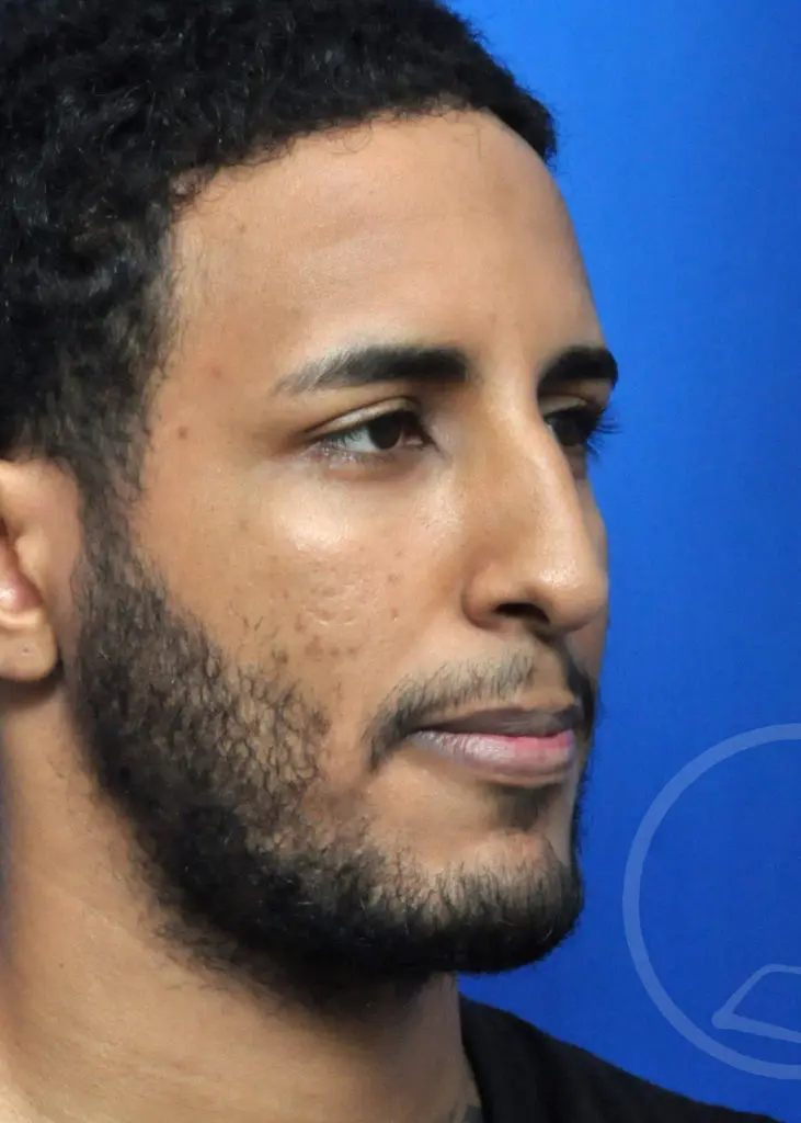 Plastic Surgery Before and After Pictures in Jacksonville, FL - Garcia Facial Plastic Surgery