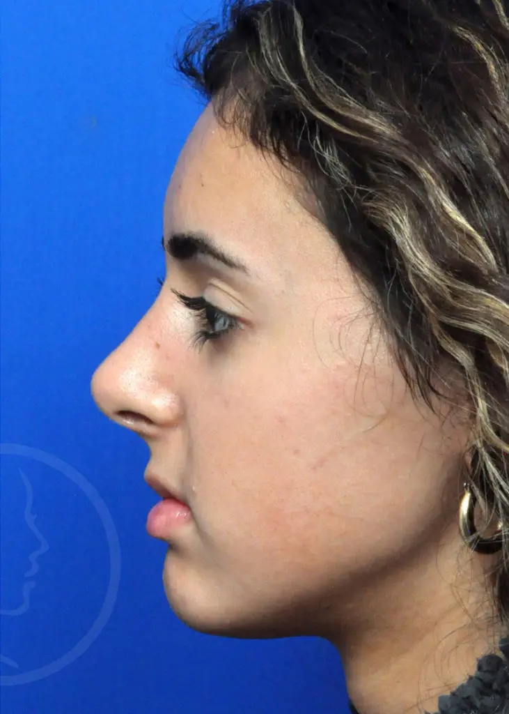 Plastic Surgery Before and After Pictures in Jacksonville, FL - Garcia Facial Plastic Surgery