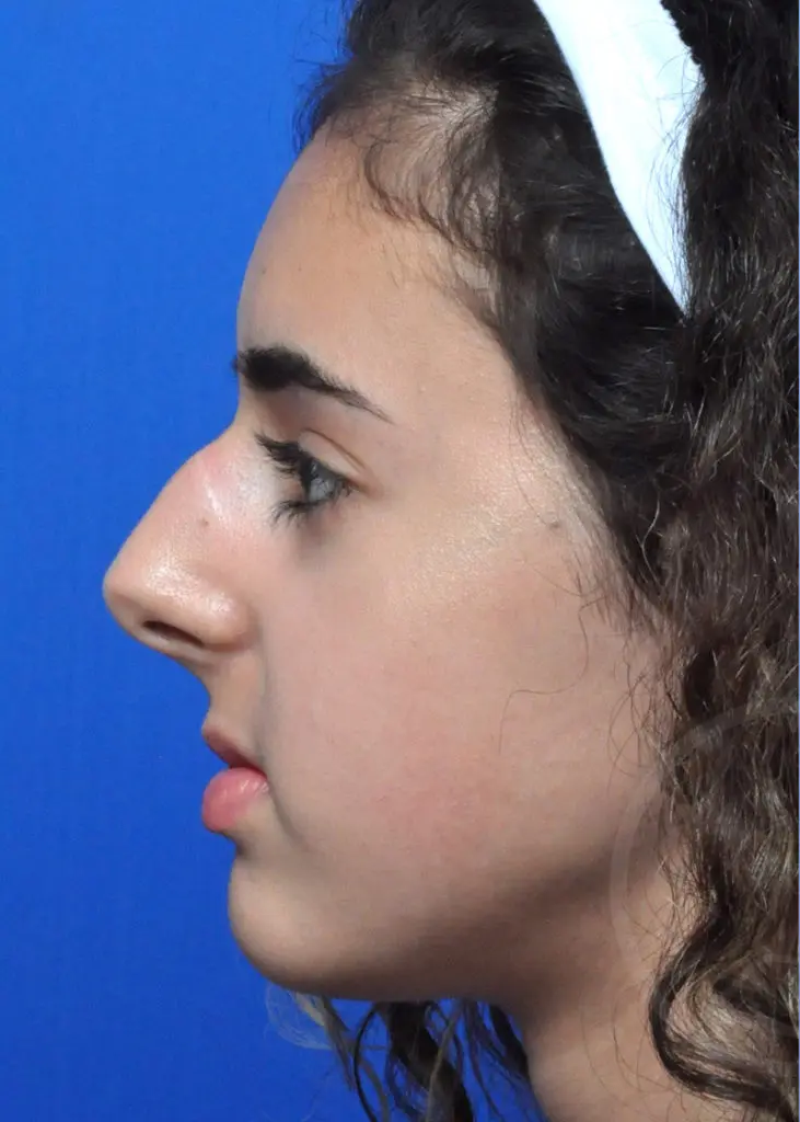 Plastic Surgery Before and After Pictures in Jacksonville, FL - Garcia Facial Plastic Surgery