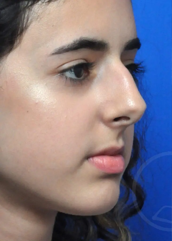 Plastic Surgery Before and After Pictures in Jacksonville, FL - Garcia Facial Plastic Surgery