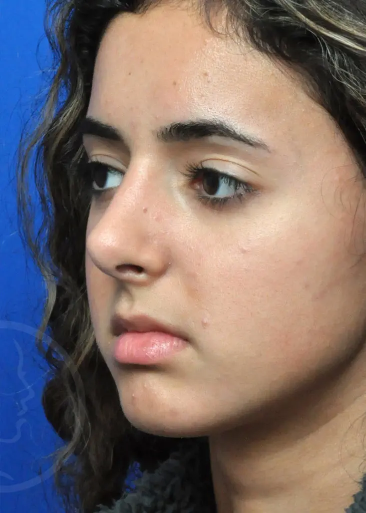 Plastic Surgery Before and After Pictures in Jacksonville, FL - Garcia Facial Plastic Surgery