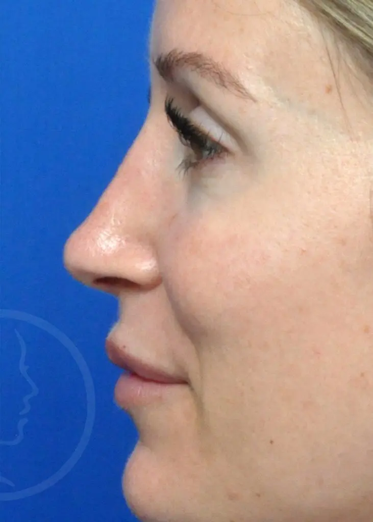 Plastic Surgery Before and After Pictures in Jacksonville, FL - Garcia Facial Plastic Surgery