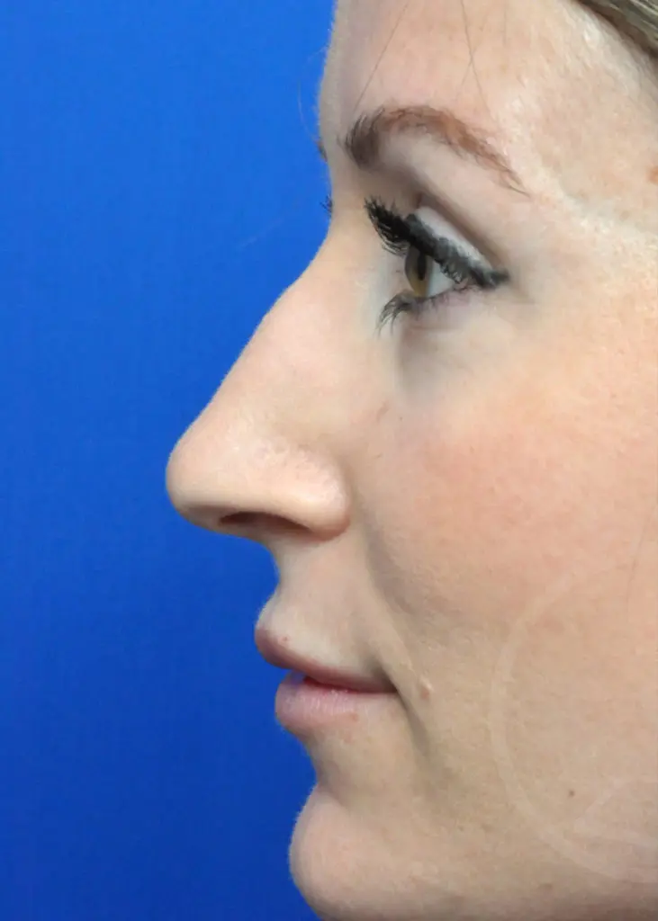 Plastic Surgery Before and After Pictures in Jacksonville, FL - Garcia Facial Plastic Surgery