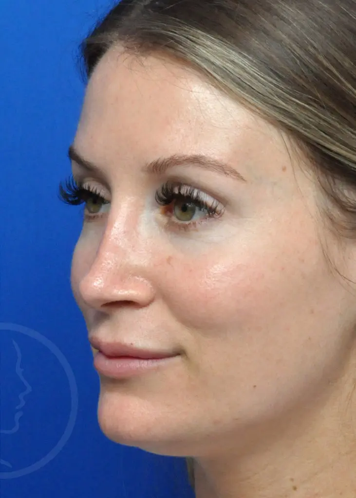 Plastic Surgery Before and After Pictures in Jacksonville, FL - Garcia Facial Plastic Surgery