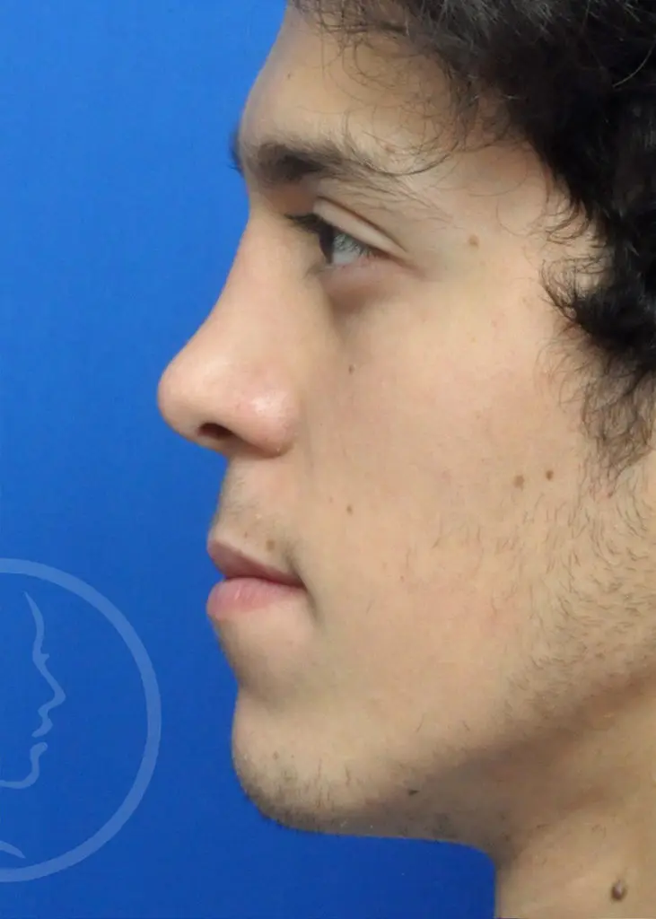 Plastic Surgery Before and After Pictures in Jacksonville, FL - Garcia Facial Plastic Surgery