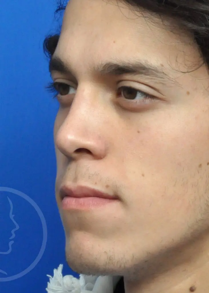 Plastic Surgery Before and After Pictures in Jacksonville, FL - Garcia Facial Plastic Surgery