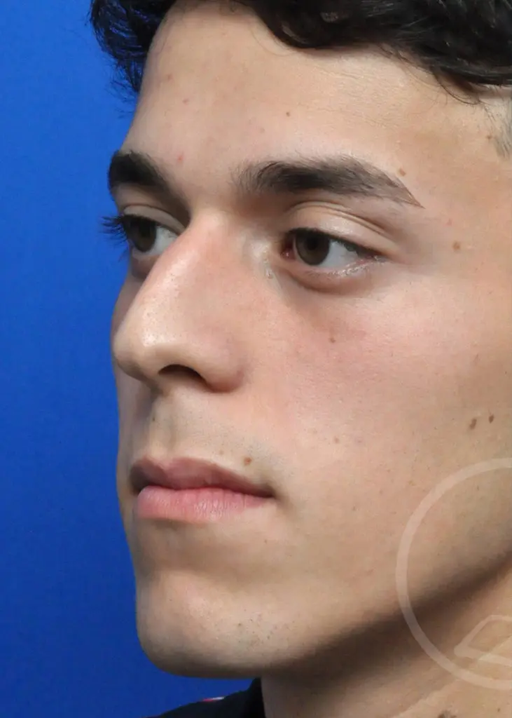 Plastic Surgery Before and After Pictures in Jacksonville, FL - Garcia Facial Plastic Surgery