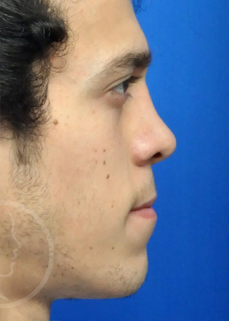 Plastic Surgery Before and After Pictures in Jacksonville, FL - Garcia Facial Plastic Surgery