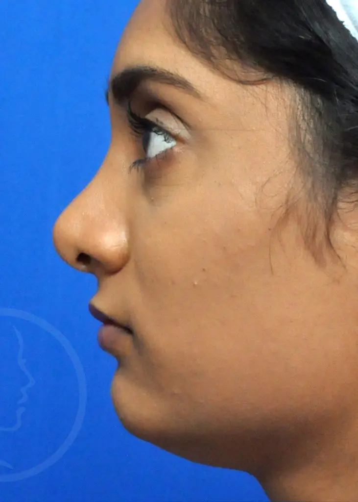 Plastic Surgery Before and After Pictures in Jacksonville, FL - Garcia Facial Plastic Surgery