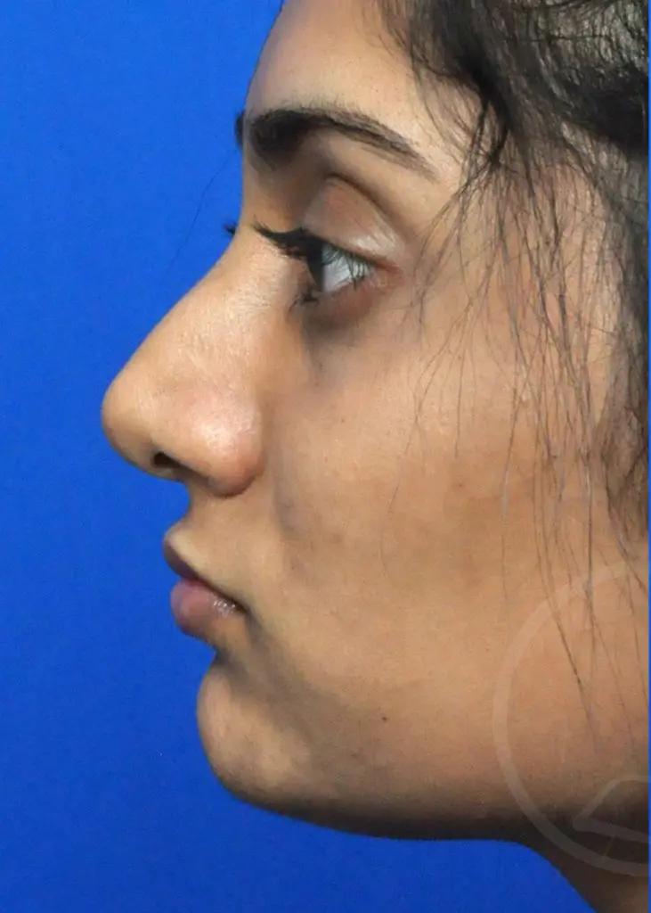 Plastic Surgery Before and After Pictures in Jacksonville, FL - Garcia Facial Plastic Surgery