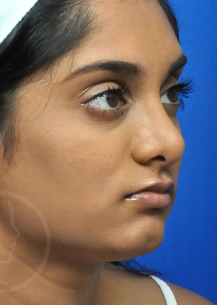 Plastic Surgery Before and After Pictures in Jacksonville, FL - Garcia Facial Plastic Surgery