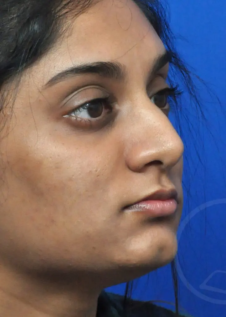 Plastic Surgery Before and After Pictures in Jacksonville, FL - Garcia Facial Plastic Surgery