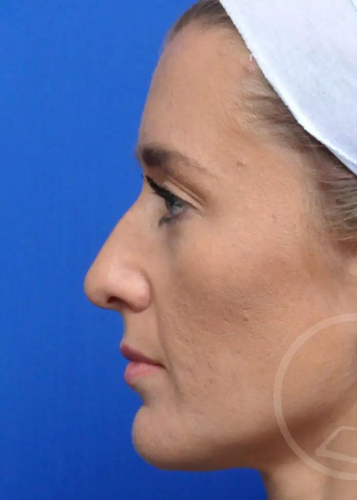 Plastic Surgery Before and After Pictures in Jacksonville, FL - Garcia Facial Plastic Surgery