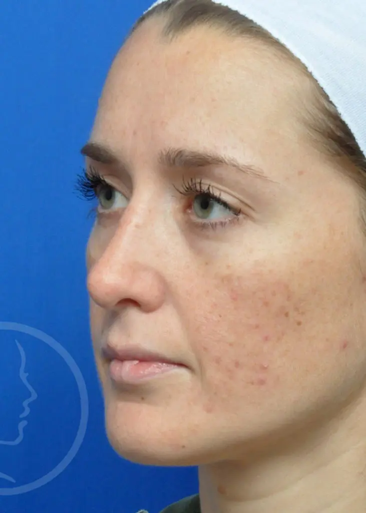 Plastic Surgery Before and After Pictures in Jacksonville, FL - Garcia Facial Plastic Surgery