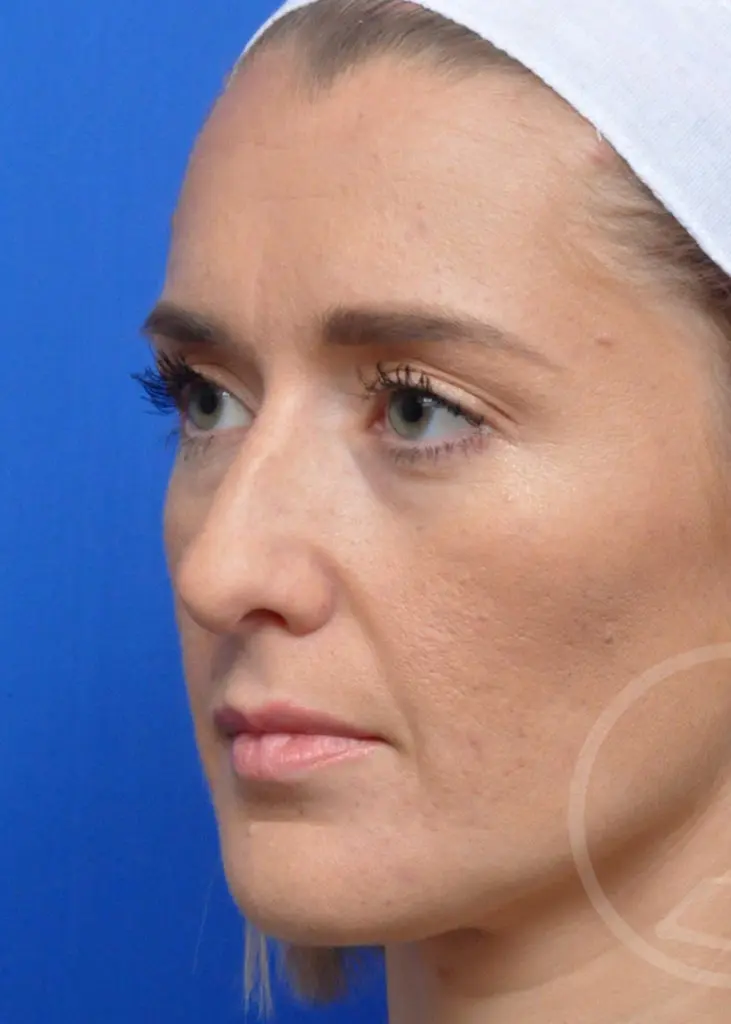 Plastic Surgery Before and After Pictures in Jacksonville, FL - Garcia Facial Plastic Surgery