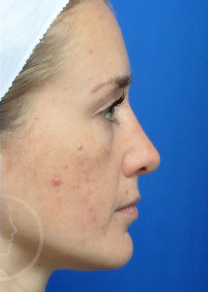 Plastic Surgery Before and After Pictures in Jacksonville, FL - Garcia Facial Plastic Surgery