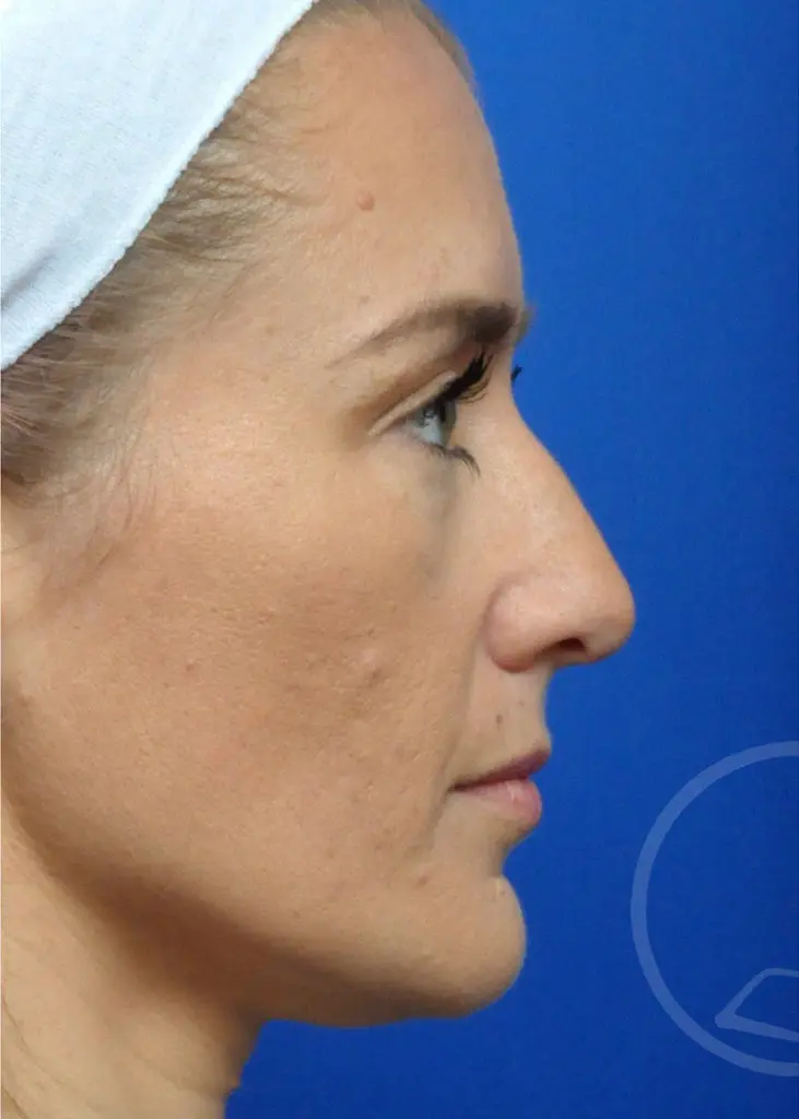 Plastic Surgery Before and After Pictures in Jacksonville, FL - Garcia Facial Plastic Surgery