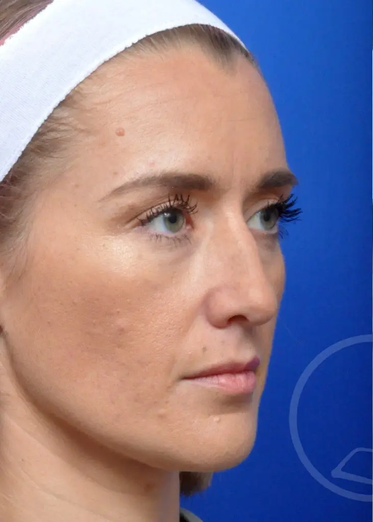 Plastic Surgery Before and After Pictures in Jacksonville, FL - Garcia Facial Plastic Surgery