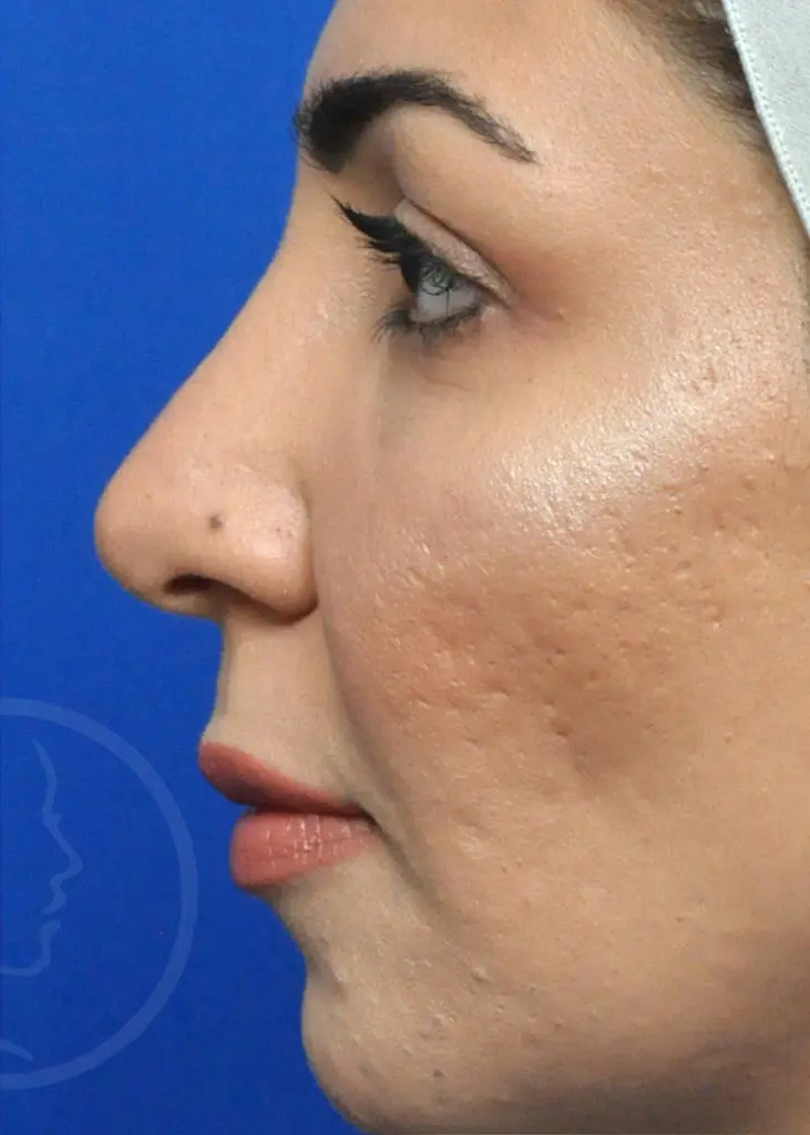 Plastic Surgery Before and After Pictures in Jacksonville, FL - Garcia Facial Plastic Surgery