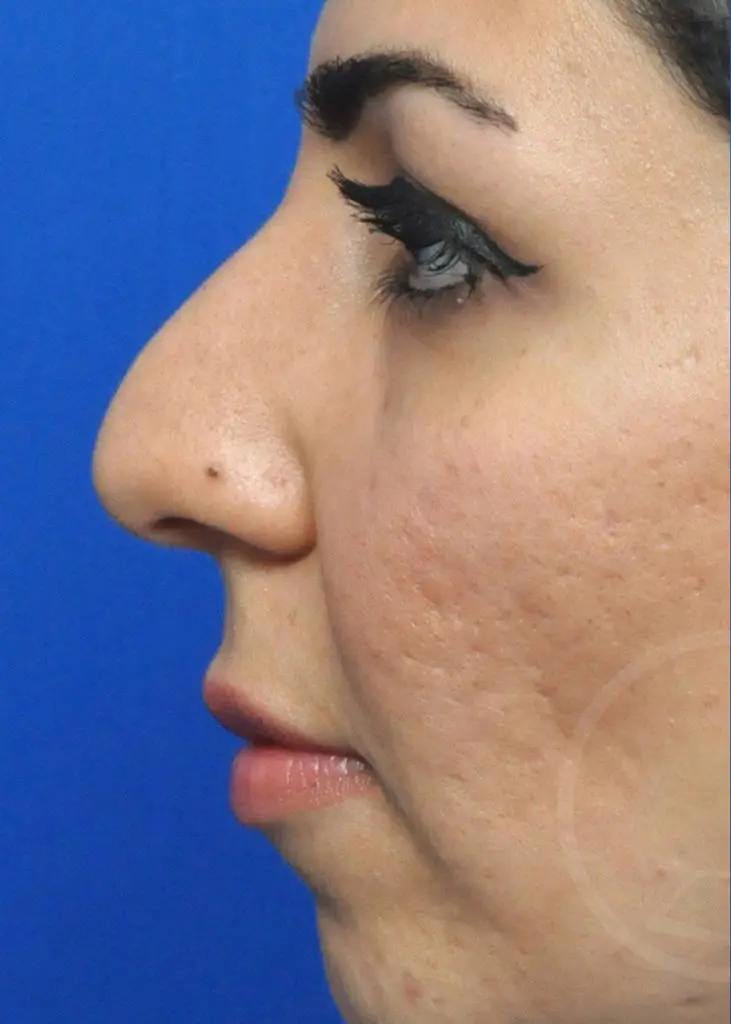 Plastic Surgery Before and After Pictures in Jacksonville, FL - Garcia Facial Plastic Surgery
