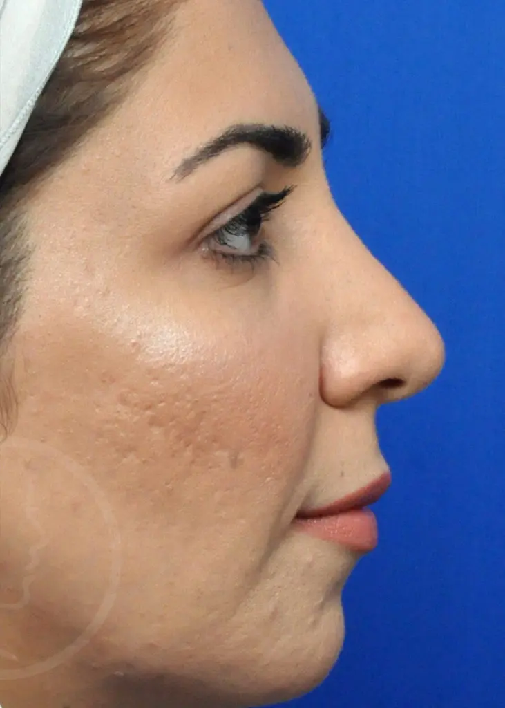 Plastic Surgery Before and After Pictures in Jacksonville, FL - Garcia Facial Plastic Surgery