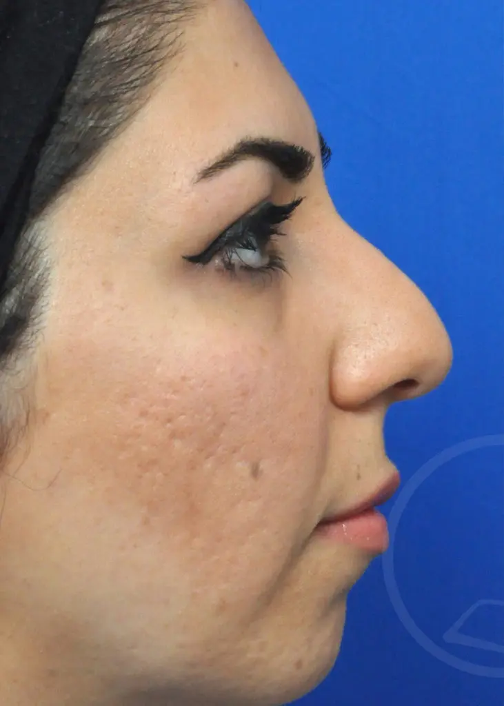 Plastic Surgery Before and After Pictures in Jacksonville, FL - Garcia Facial Plastic Surgery