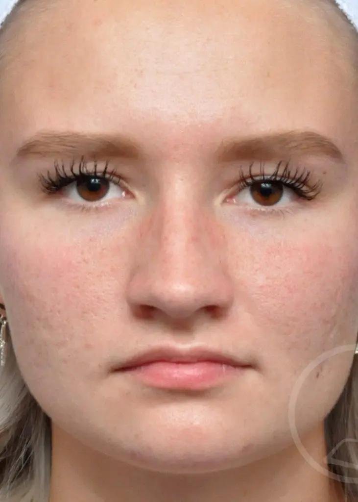 Plastic Surgery Before and After Pictures in Jacksonville, FL - Garcia Facial Plastic Surgery