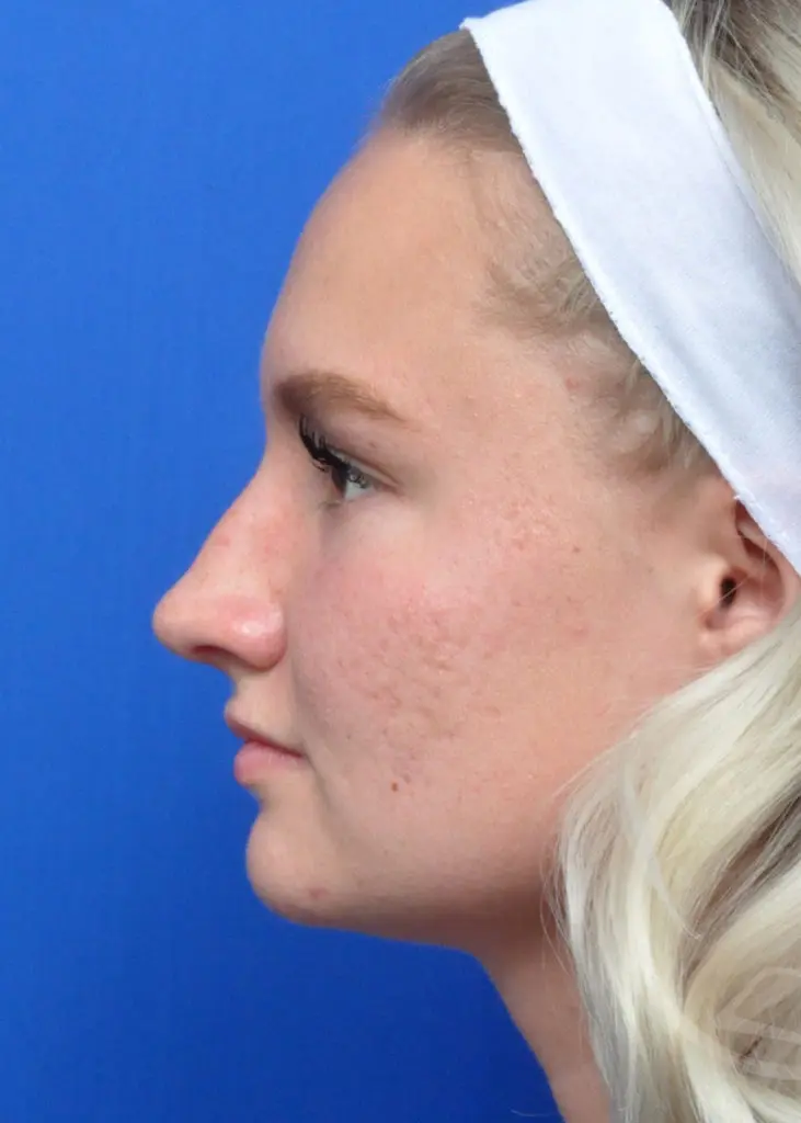 Plastic Surgery Before and After Pictures in Jacksonville, FL - Garcia Facial Plastic Surgery