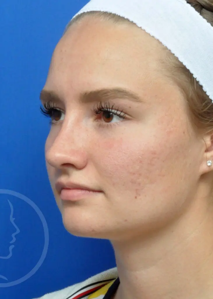 Plastic Surgery Before and After Pictures in Jacksonville, FL - Garcia Facial Plastic Surgery