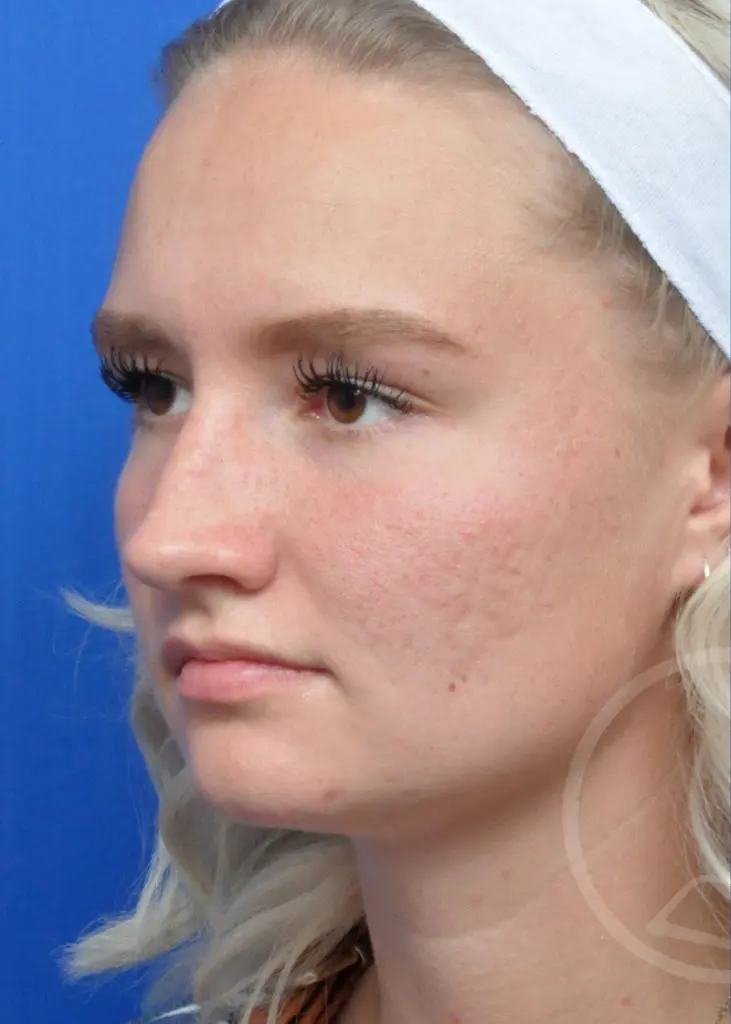 Plastic Surgery Before and After Pictures in Jacksonville, FL - Garcia Facial Plastic Surgery