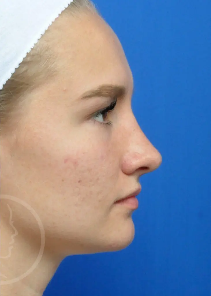 Plastic Surgery Before and After Pictures in Jacksonville, FL - Garcia Facial Plastic Surgery