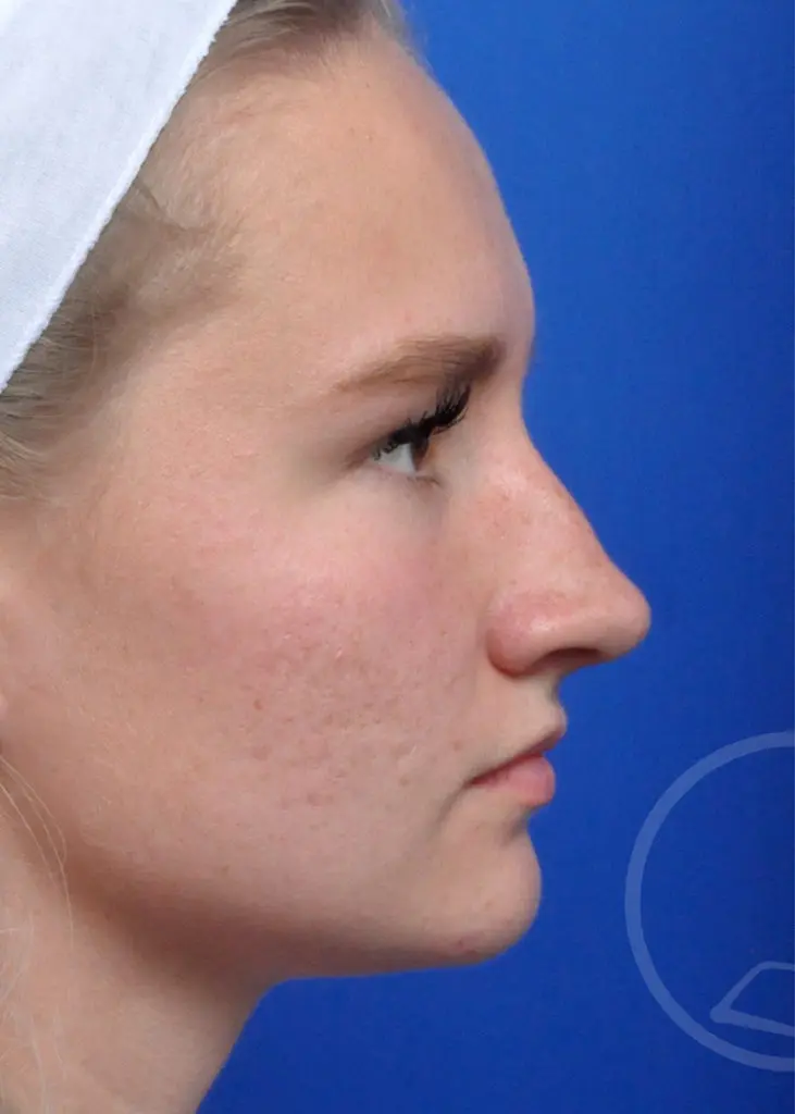 Plastic Surgery Before and After Pictures in Jacksonville, FL - Garcia Facial Plastic Surgery