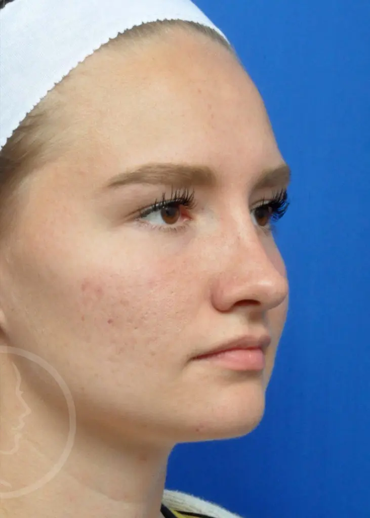 Plastic Surgery Before and After Pictures in Jacksonville, FL - Garcia Facial Plastic Surgery