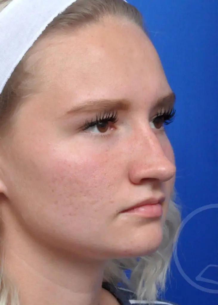 Plastic Surgery Before and After Pictures in Jacksonville, FL - Garcia Facial Plastic Surgery