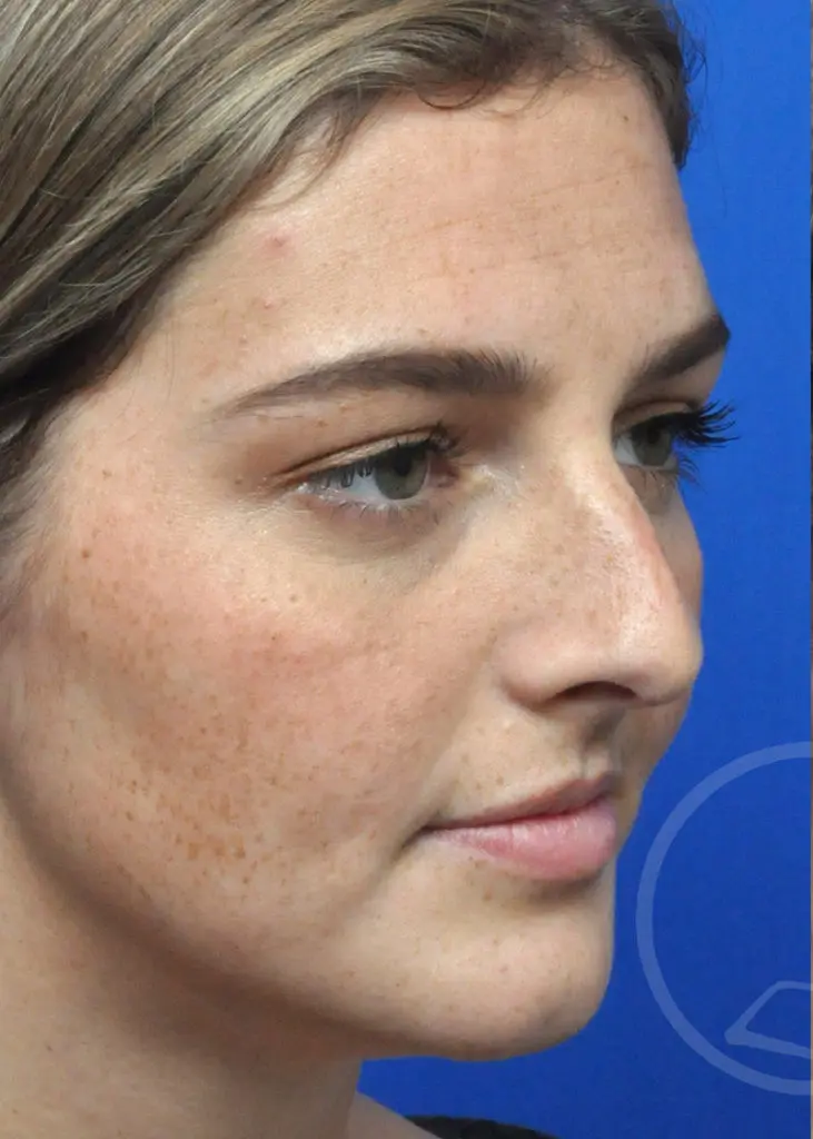 Plastic Surgery Before and After Pictures in Jacksonville, FL - Garcia Facial Plastic Surgery