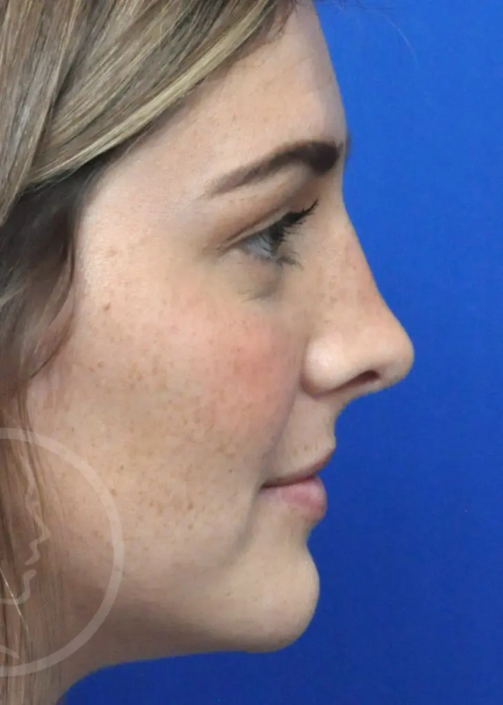 Plastic Surgery Before and After Pictures in Jacksonville, FL - Garcia Facial Plastic Surgery