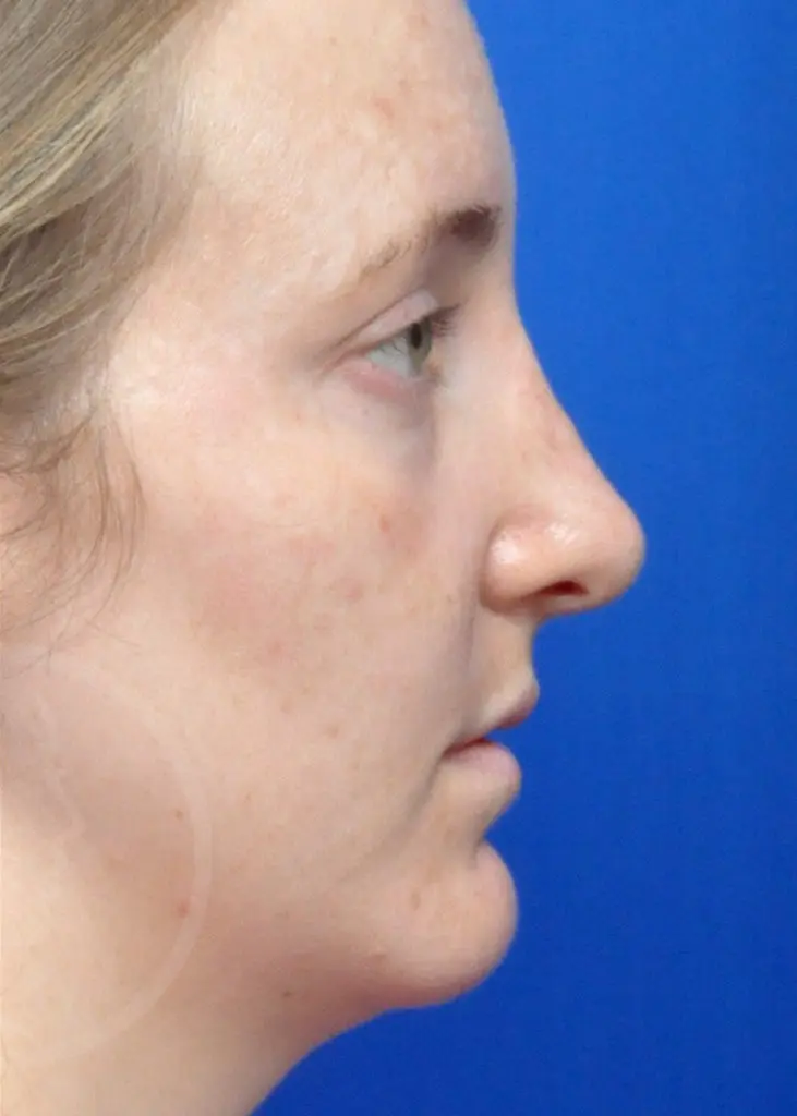 Plastic Surgery Before and After Pictures in Jacksonville, FL - Garcia Facial Plastic Surgery
