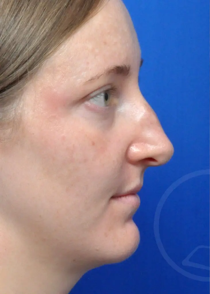 Plastic Surgery Before and After Pictures in Jacksonville, FL - Garcia Facial Plastic Surgery