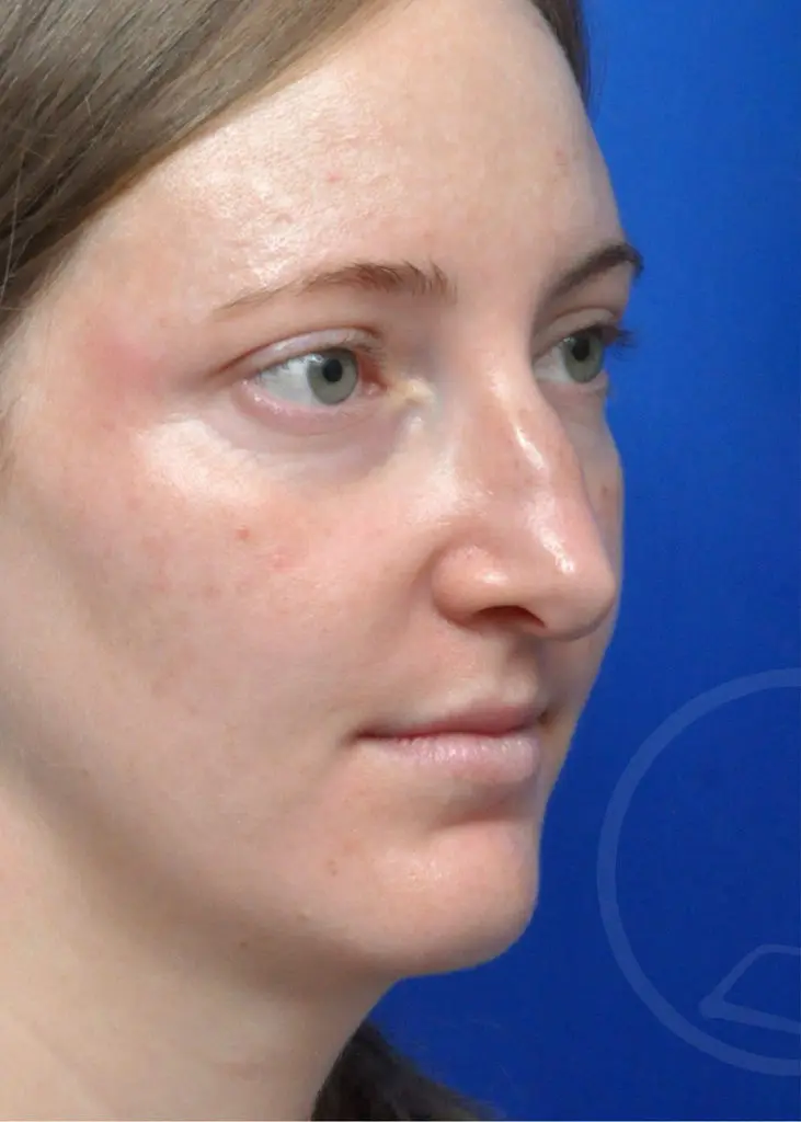 Plastic Surgery Before and After Pictures in Jacksonville, FL - Garcia Facial Plastic Surgery