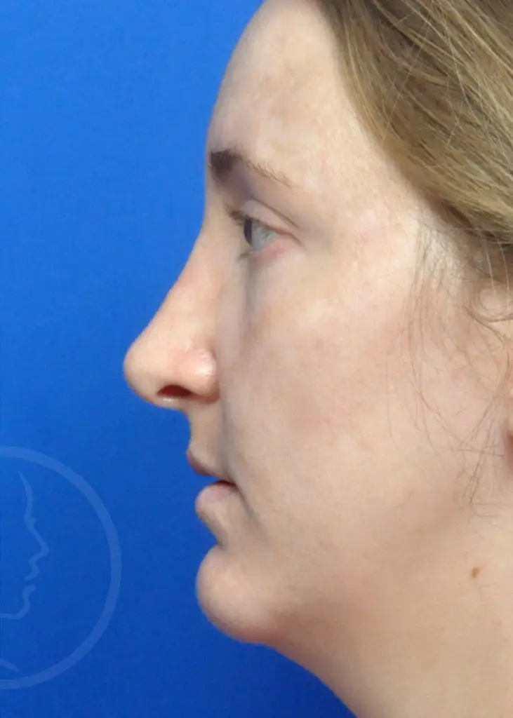 Plastic Surgery Before and After Pictures in Jacksonville, FL - Garcia Facial Plastic Surgery