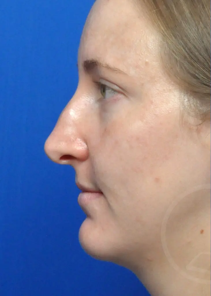 Plastic Surgery Before and After Pictures in Jacksonville, FL - Garcia Facial Plastic Surgery