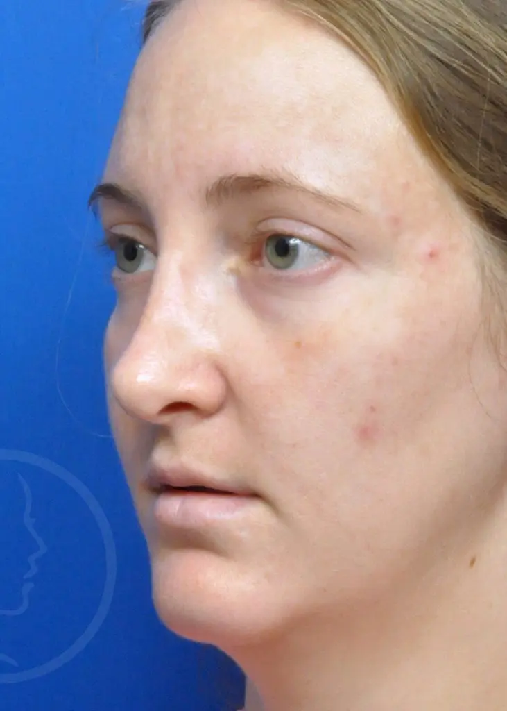 Plastic Surgery Before and After Pictures in Jacksonville, FL - Garcia Facial Plastic Surgery