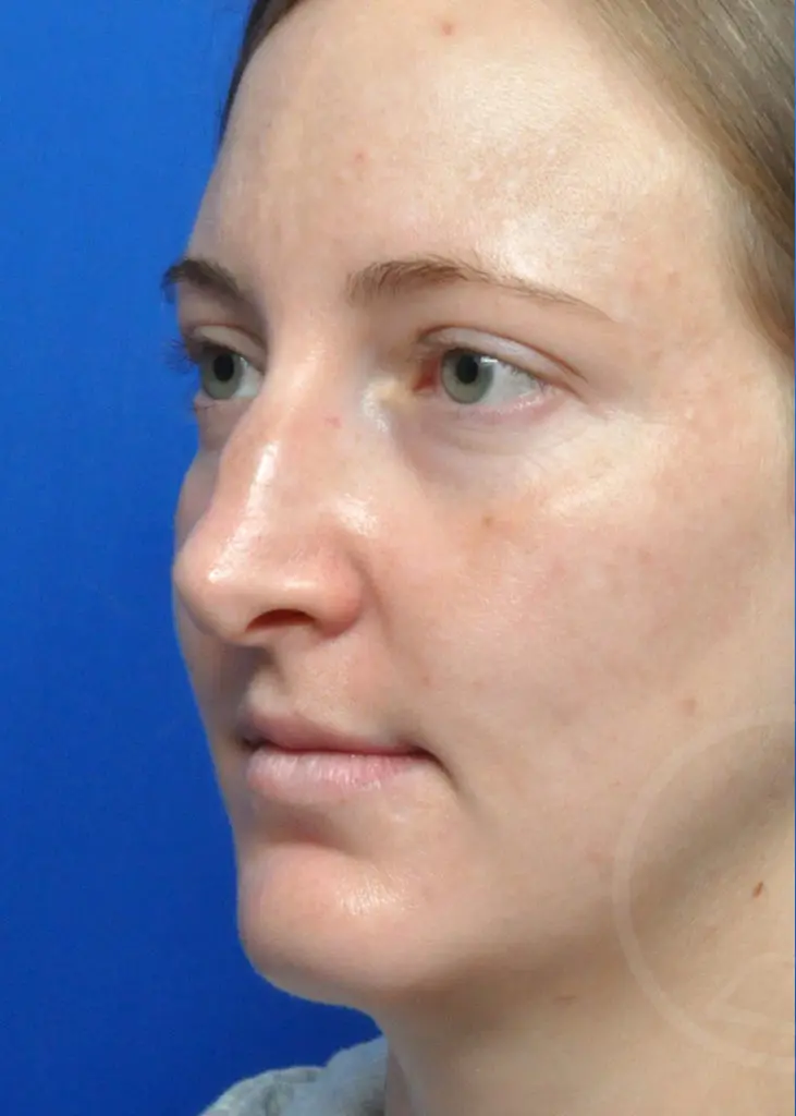 Plastic Surgery Before and After Pictures in Jacksonville, FL - Garcia Facial Plastic Surgery