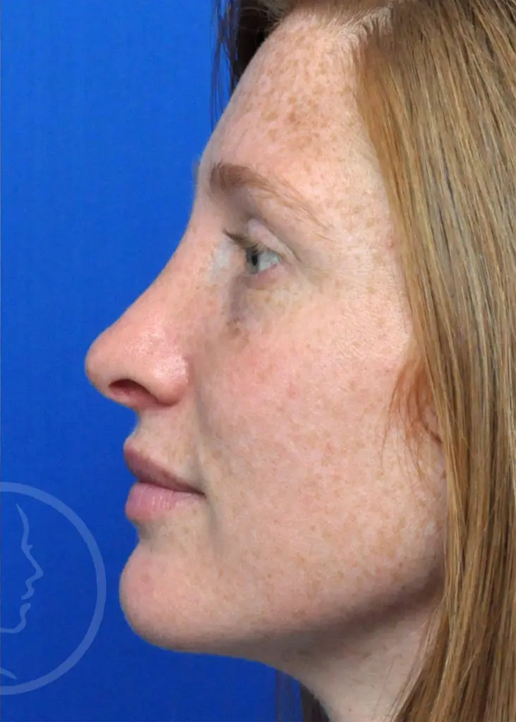 Plastic Surgery Before and After Pictures in Jacksonville, FL - Garcia Facial Plastic Surgery