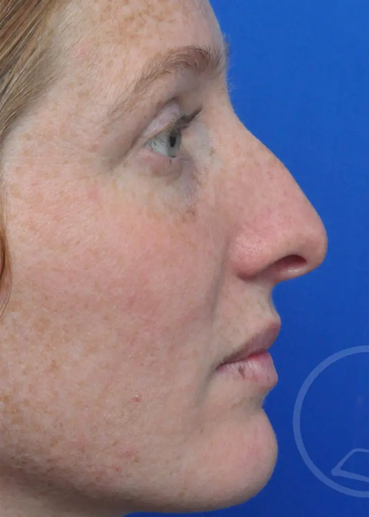 Plastic Surgery Before and After Pictures in Jacksonville, FL - Garcia Facial Plastic Surgery