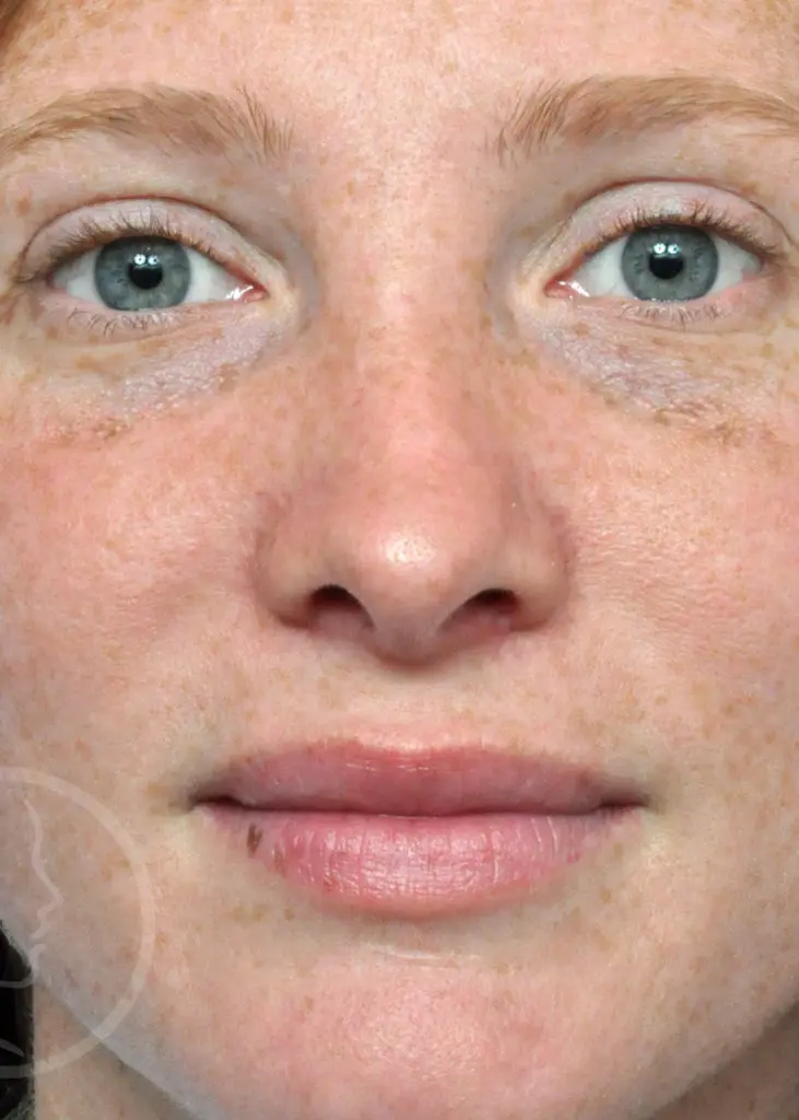 Plastic Surgery Before and After Pictures in Jacksonville, FL - Garcia Facial Plastic Surgery